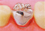 金パラジウム冠